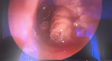 Yer: Bursa! Kulağından canlı canlı çıktı!