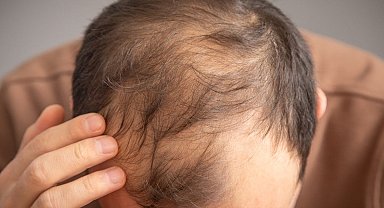 Erkeklerde kelliğe neden olan içecekler açıklandı